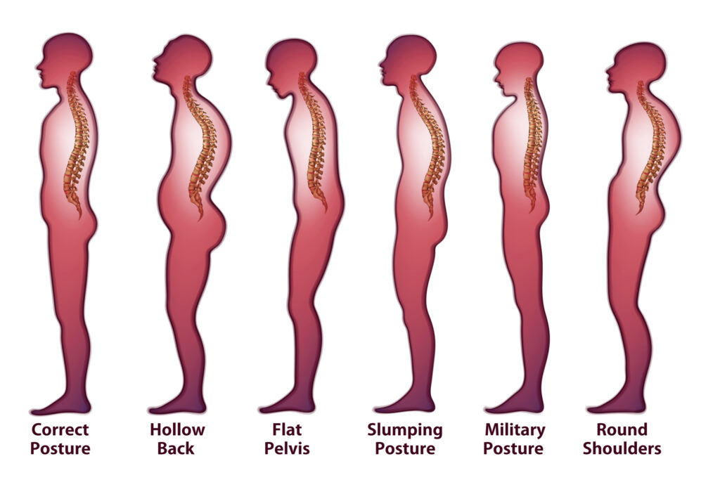 Top Tips to Improve Bad Posture & Have Good Posture