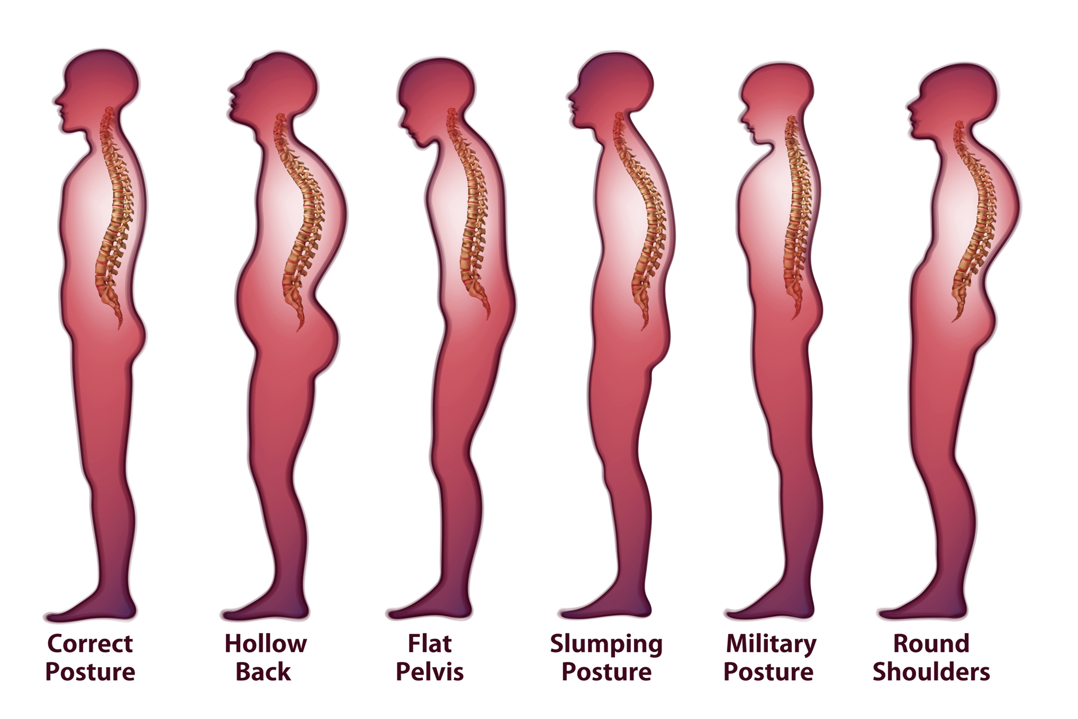 How To Know You Have Flat Back Posture